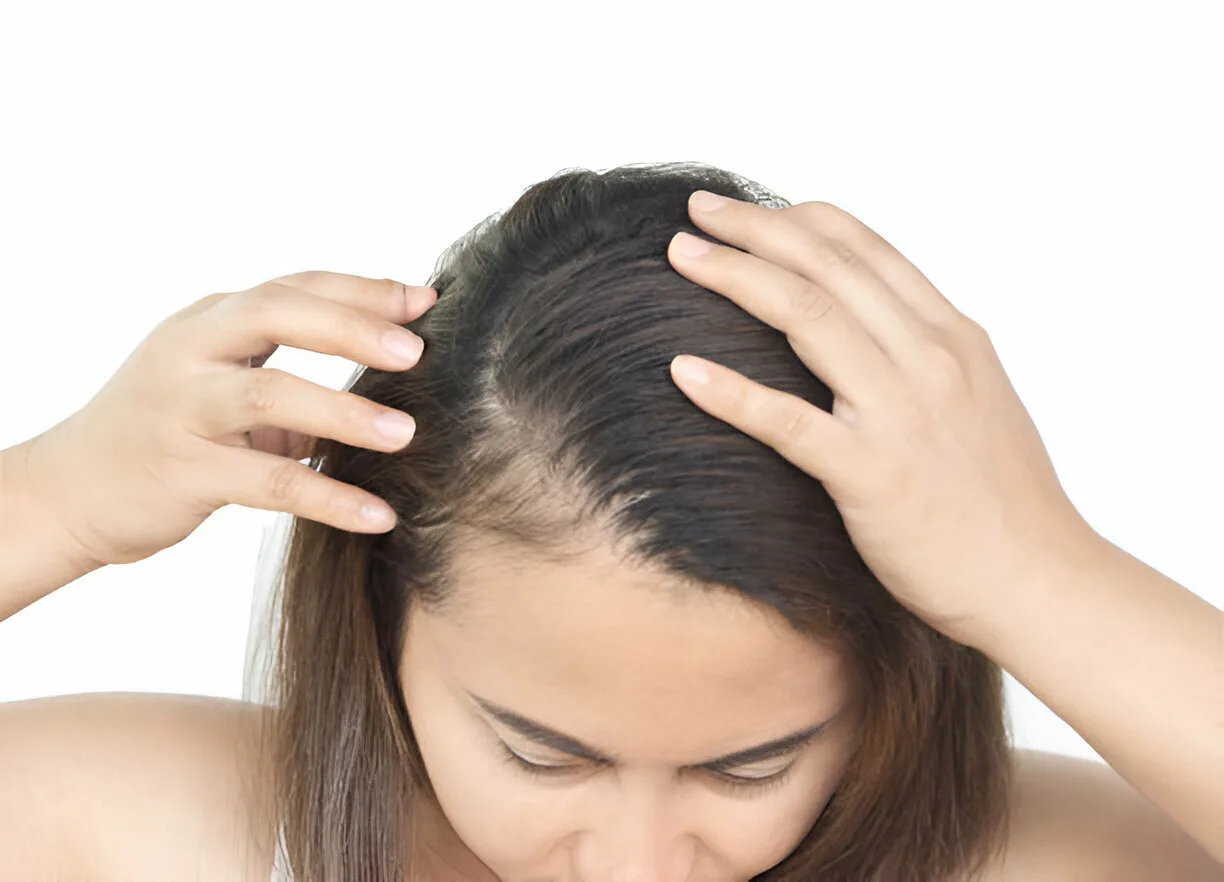 Why Does Hair Fall Increase During The Monsoon? Causes and Prevention