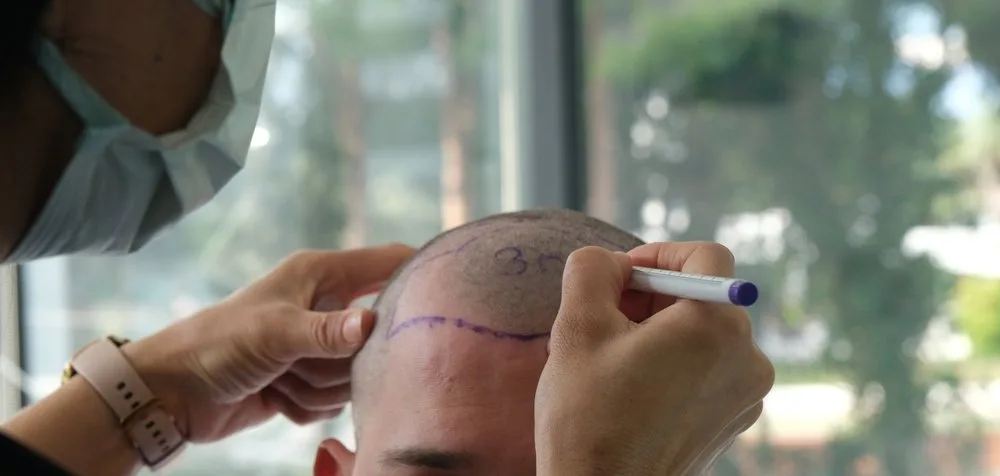 What to Expect From Your Hair Transplant Timeline