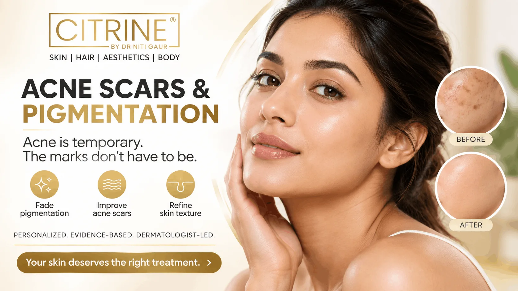 Why Acne Scars and Pigmentation Occur and How They Can Be Treated?