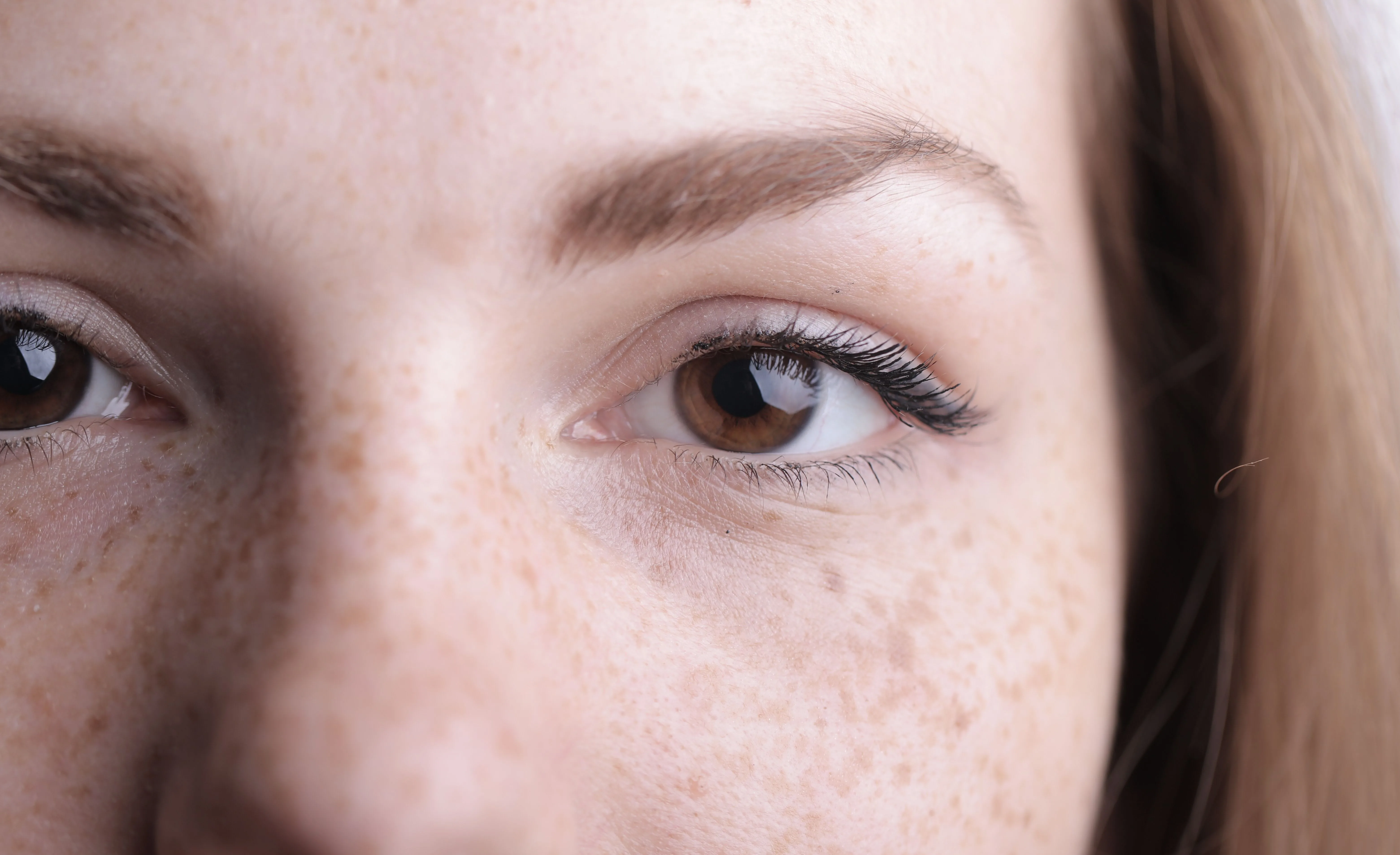 Considering Laser for Melasma? Questions to Ask at Your First Consultation