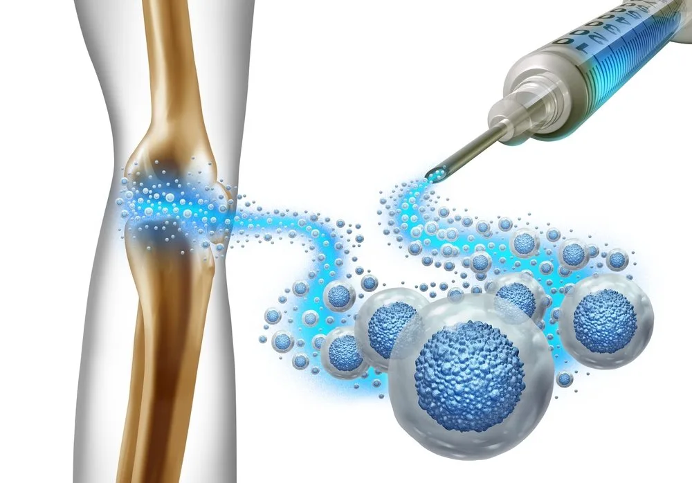 Stem Cell Therapy for Arthritis: Research, Potential Benefits, and Safety Considerations