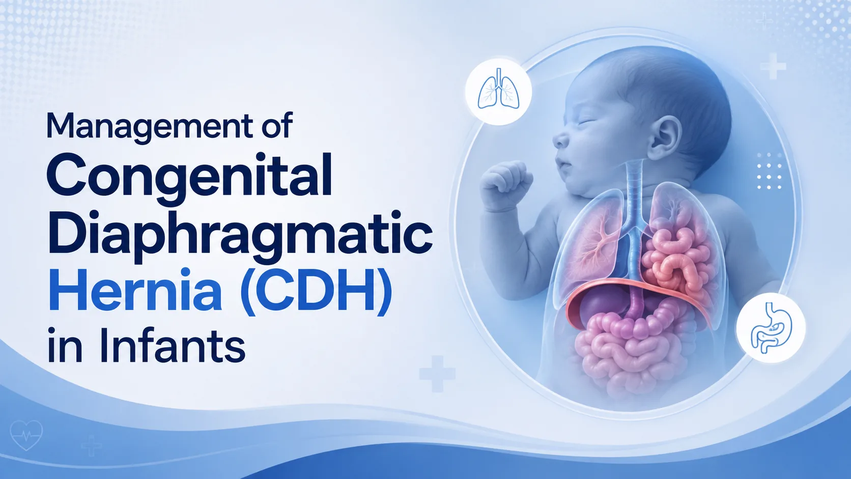 Management of Congenital Diaphragmatic Hernia (CDH) in Infants