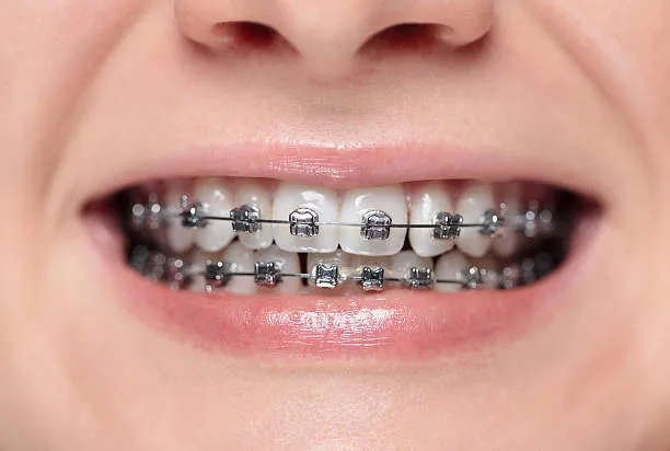 Everything You Need to Know Before Getting Braces