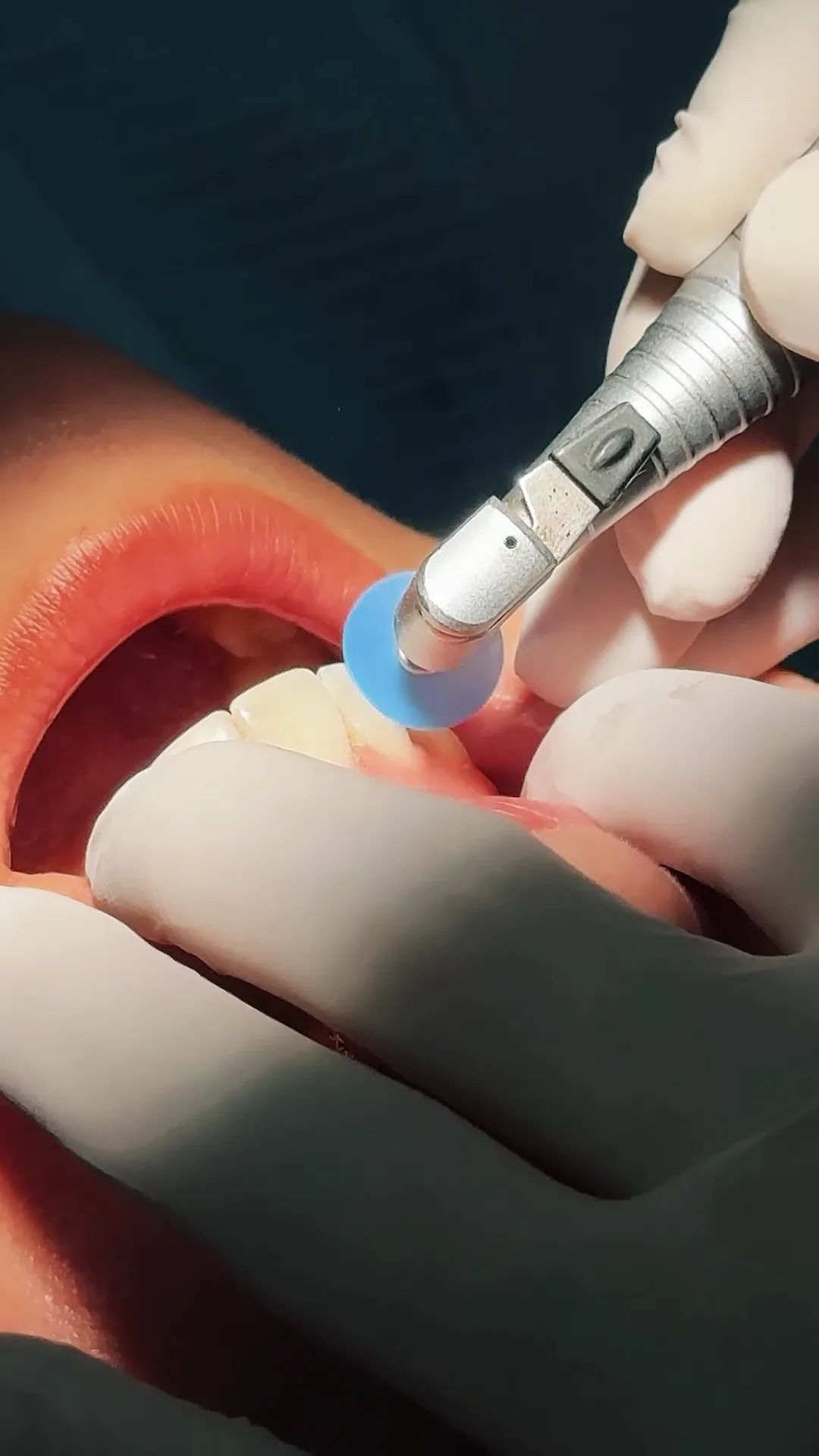 The Biomaterial Science of Teeth Bleaching: Advanced Modalities for Structural Teeth Whitening