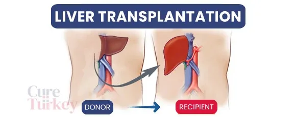 Liver Transplant in Turkey 2026: Cost, Success Rates & Best Hospitals