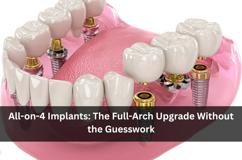 All-on-4 Implants: The Full-Arch Upgrade Without the Guesswork