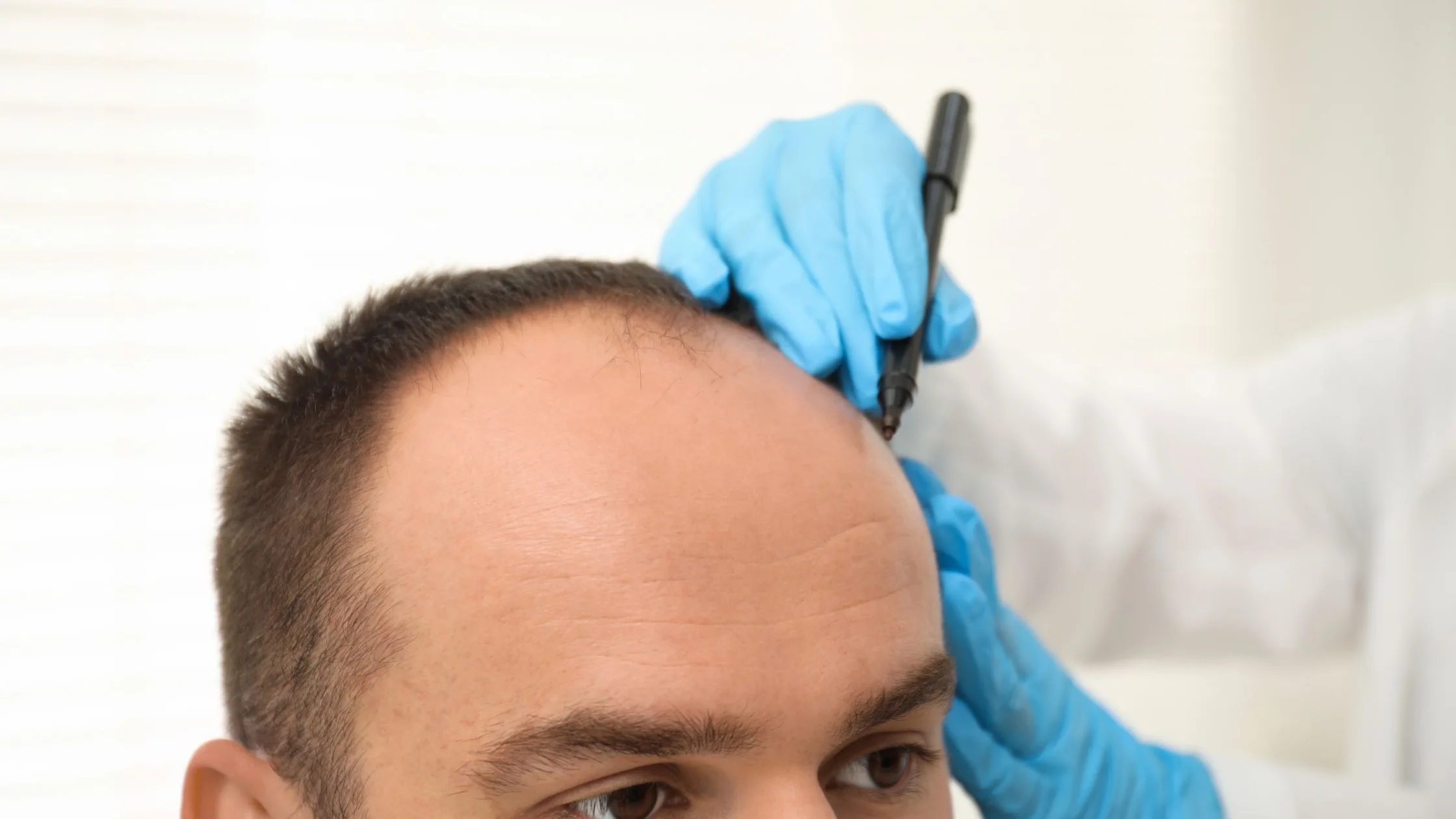 Best Hair Transplant in Mumbai: 2026 Trends, Techniques & What Patients Should Know Before Choosing a Clinic