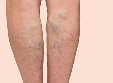 Excision Skin Cancer in Melbourne: Procedure, Recovery, and Aftercare