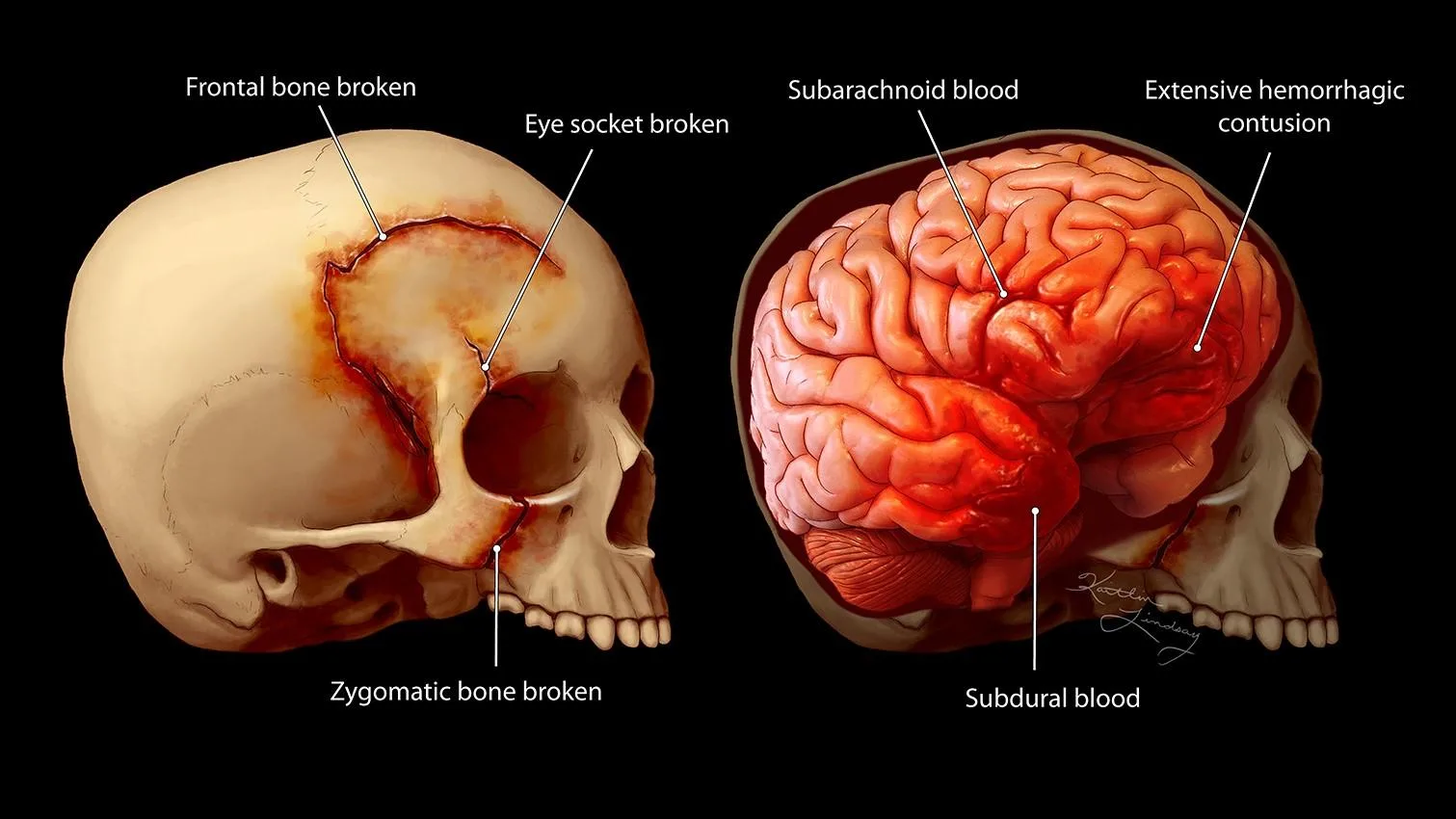 How a Brain Trauma Animator Helps Explain Medical Evidence in Court
