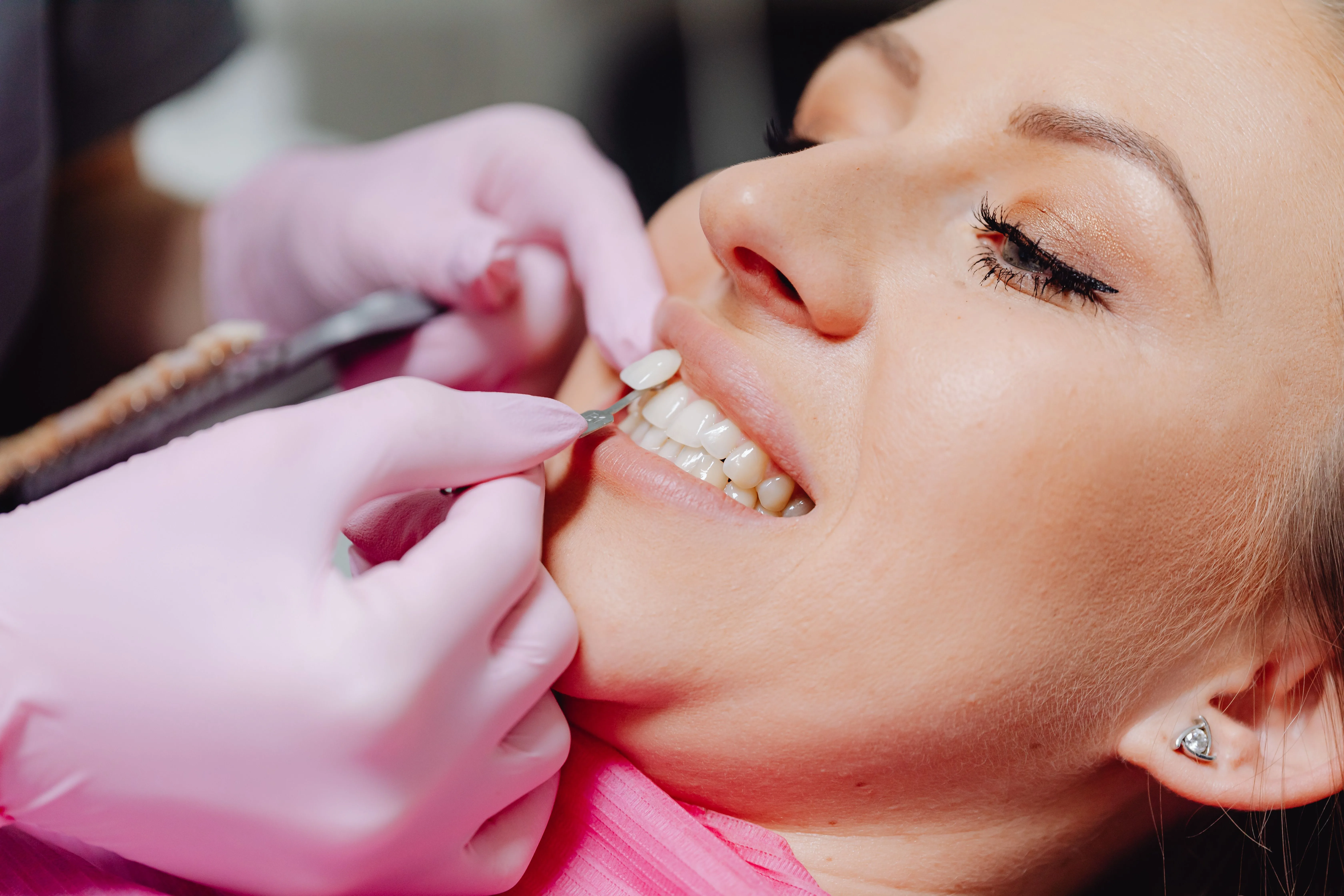 Are Cosmetic Veneers Worth the Price? Benefits and Costs