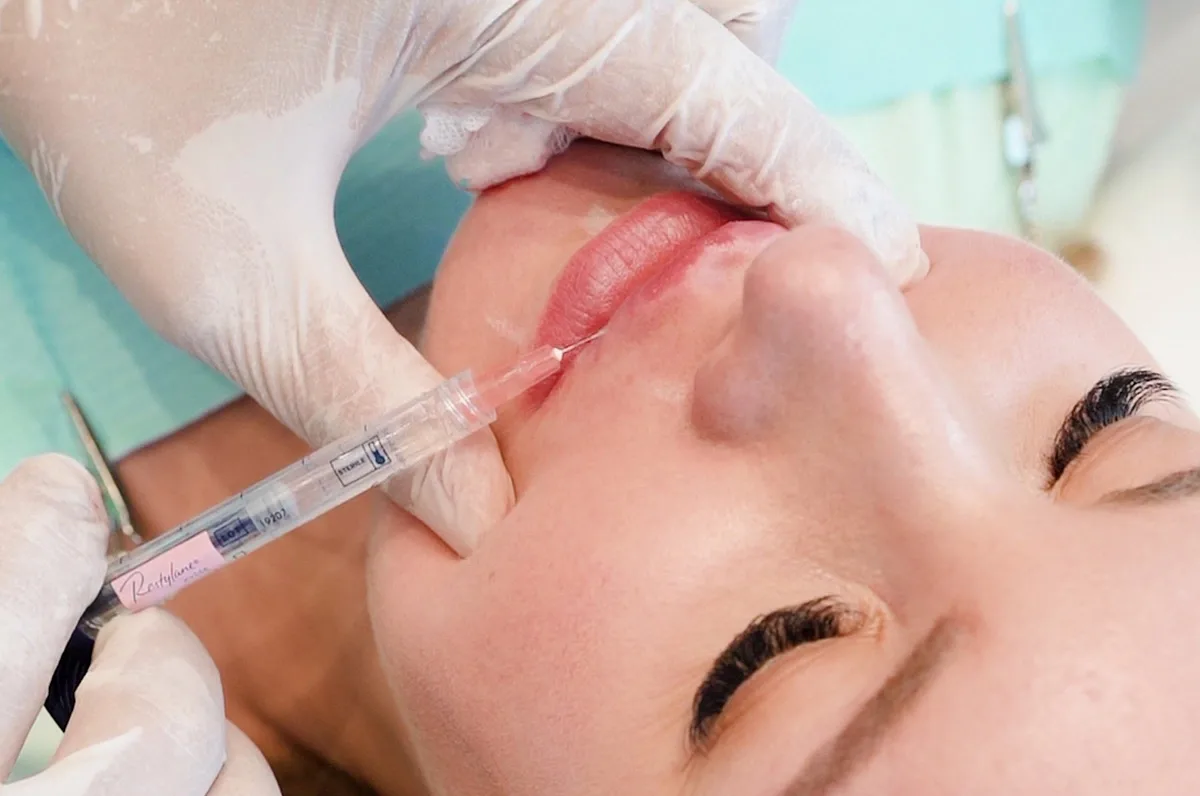 Lip Fillers in Dubai: Everything You Need to Know Before Getting the Treatment
