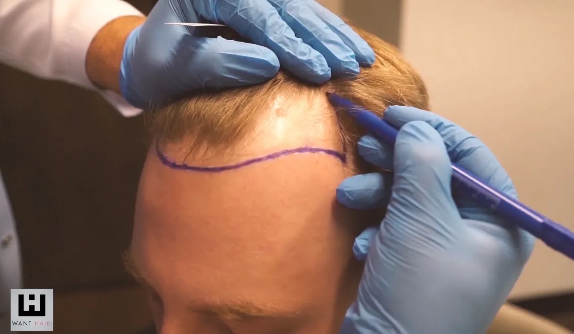 Do Hair Transplant Centres in Turkey Use Advanced FUE Techniques?
