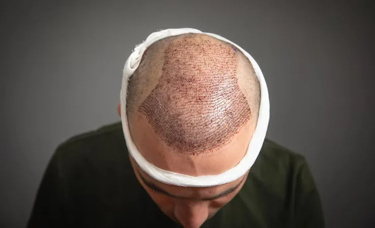 The Rise of Istanbul as a Global Destination for Hair Transplants