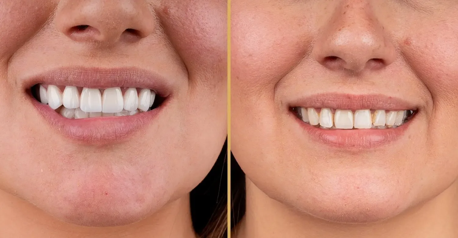 Composite Veneers in Dubai: A Modern Solution for a Confident Smile