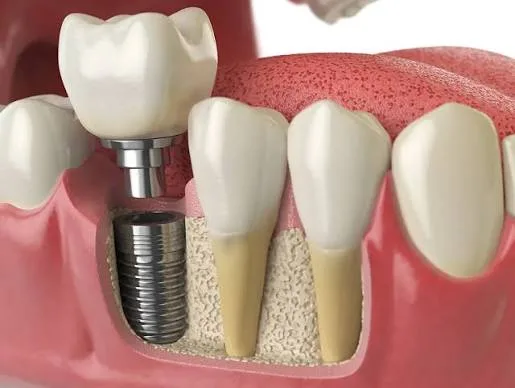 Can Dental Implants Prevent Other Teeth From Shifting?