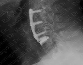 Artificial Disc Replacement in Canada: Exploring Alternatives to Spinal Fusion