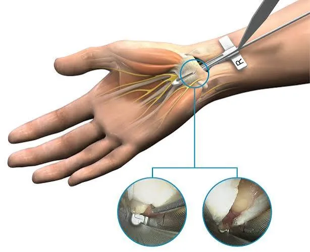 Carpal Tunnel Release Surgery: Symptoms & Recovery