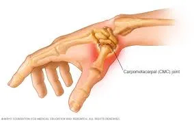 Thumb Arthritis: Best Treatment Options for Thumb Pain