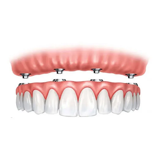Teeth in a Day for a Restored and Natural-Looking Smile