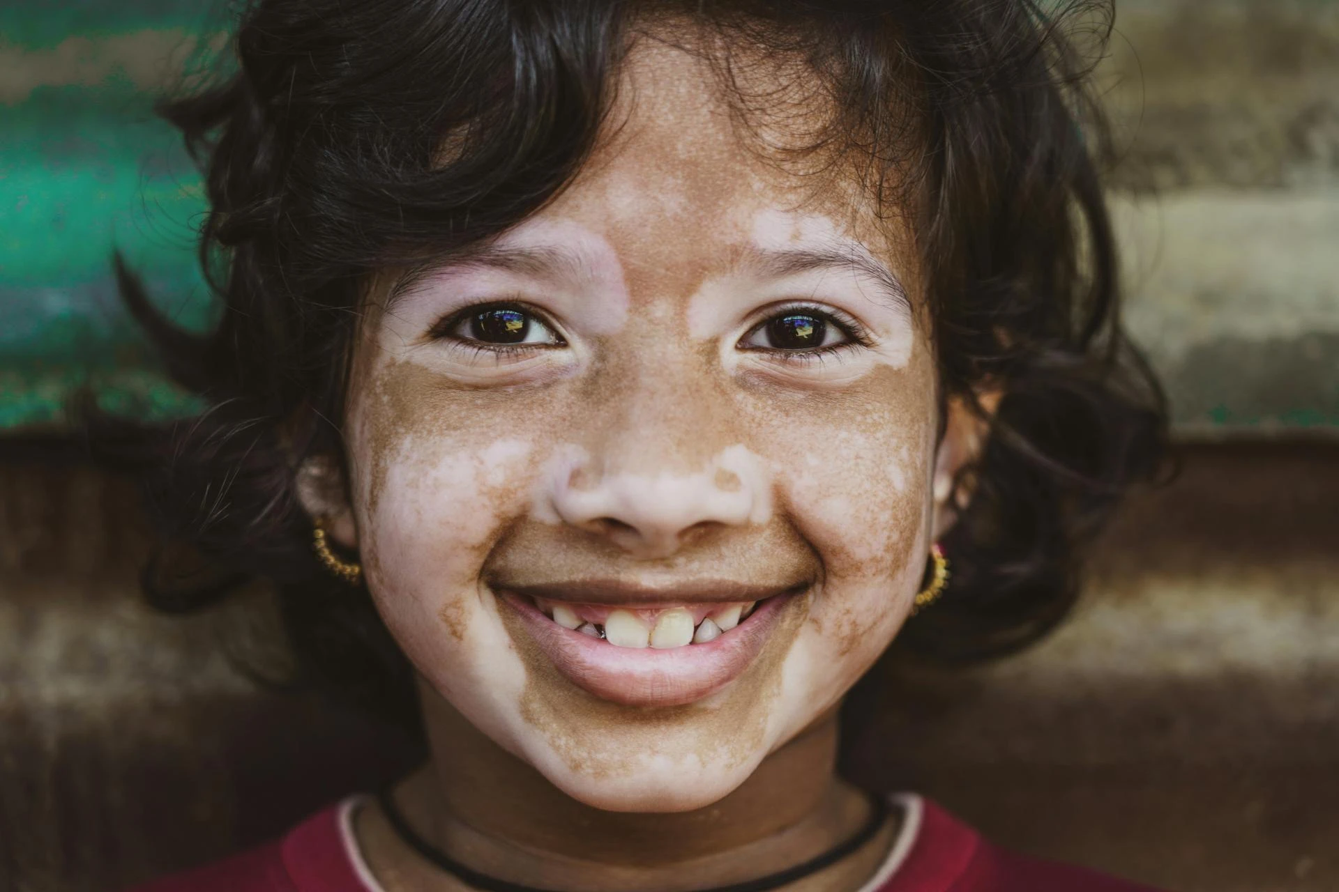 Vitiligo and You: Understanding How Homeopathy Works 