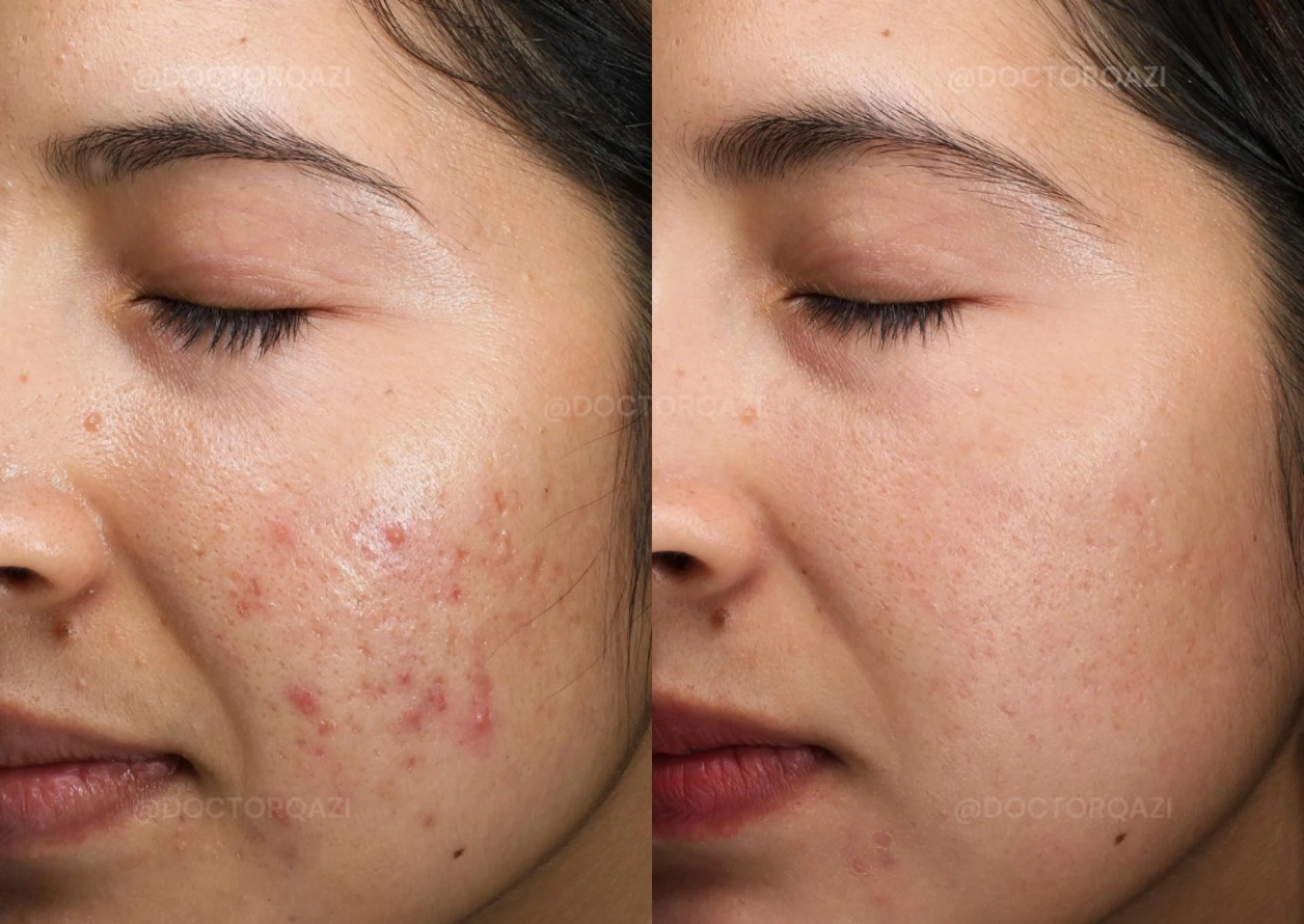Get Clear Skin Without Expensive Products from Acne Treatment in Dubai