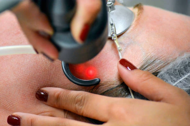Laser Treatment for Acne Scars: Benefits, Who Needs it? & Cost