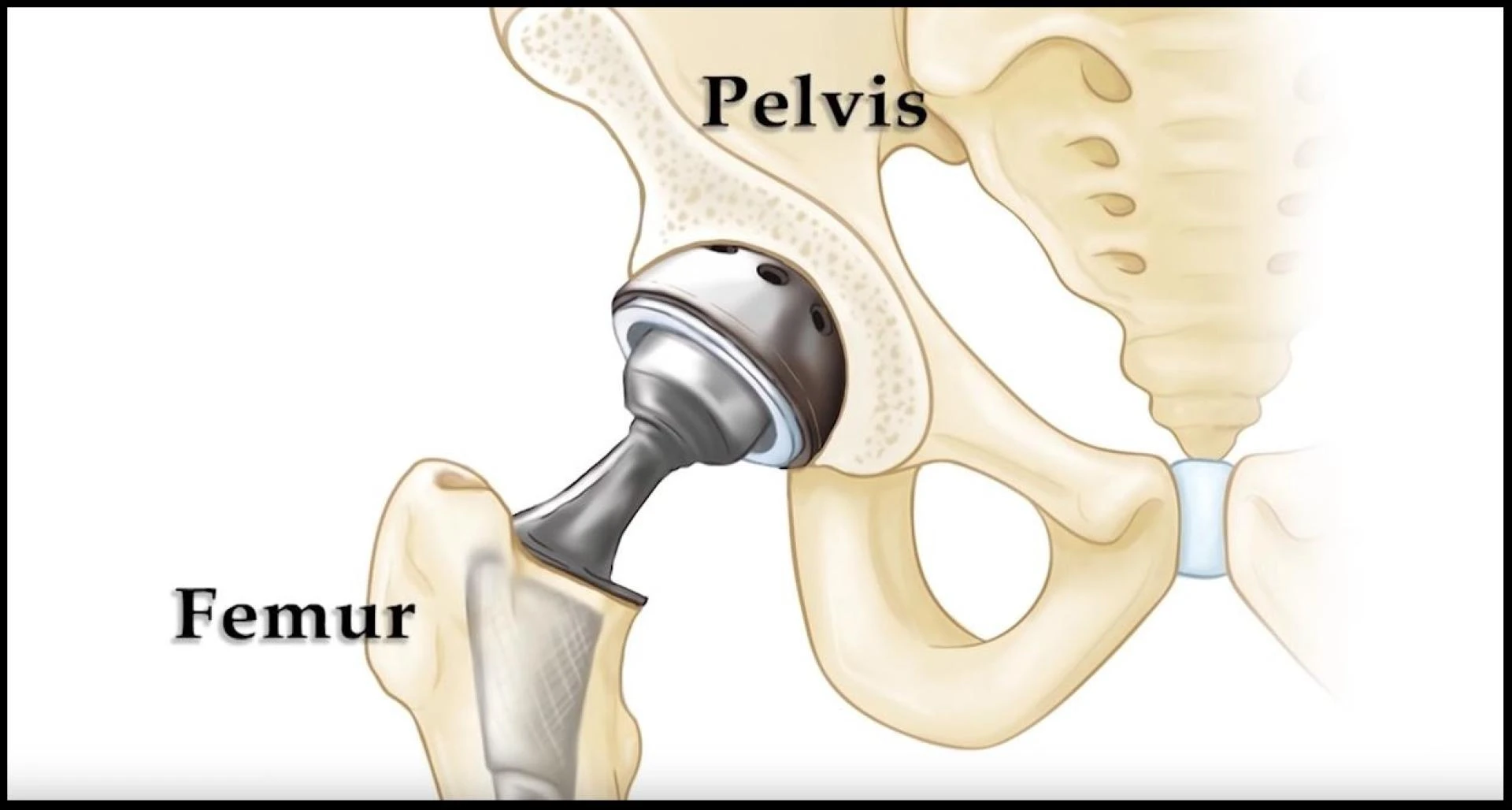 Hip Replacement In Lahore – Cost, Procedure & Best Hospitals