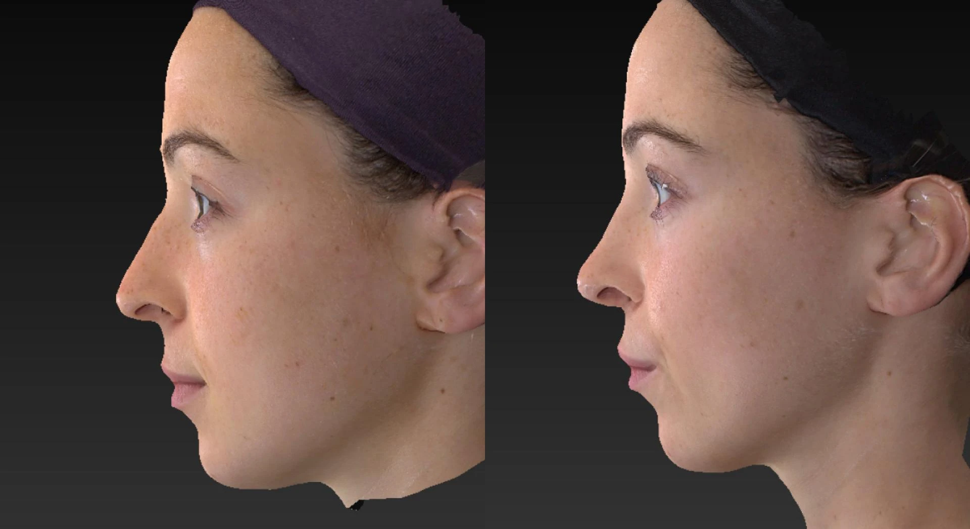 The Evolution of Rhinoplasty Techniques