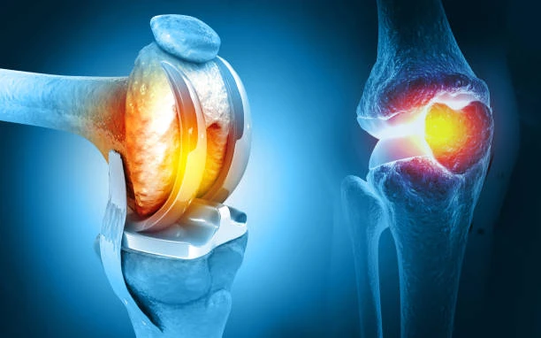 Affordable Knee Pain Treatment In Lahore That Works