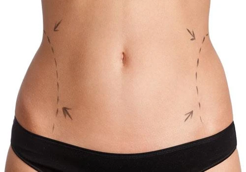 Affordable Liposuction in Dubai – Can You Get Quality for Less?