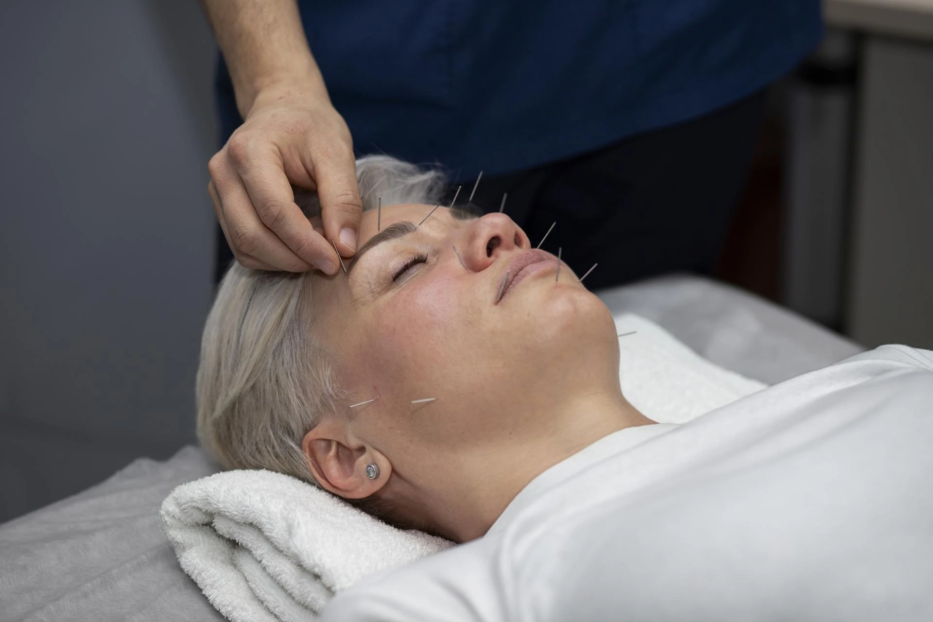 Acupuncture: A Natural Way to Ease Anxiety and Stress