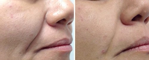 Glow & Rejuvenate: Fotona 3D, Zo Peels, Acuskin Therapy & Holistic Wellness