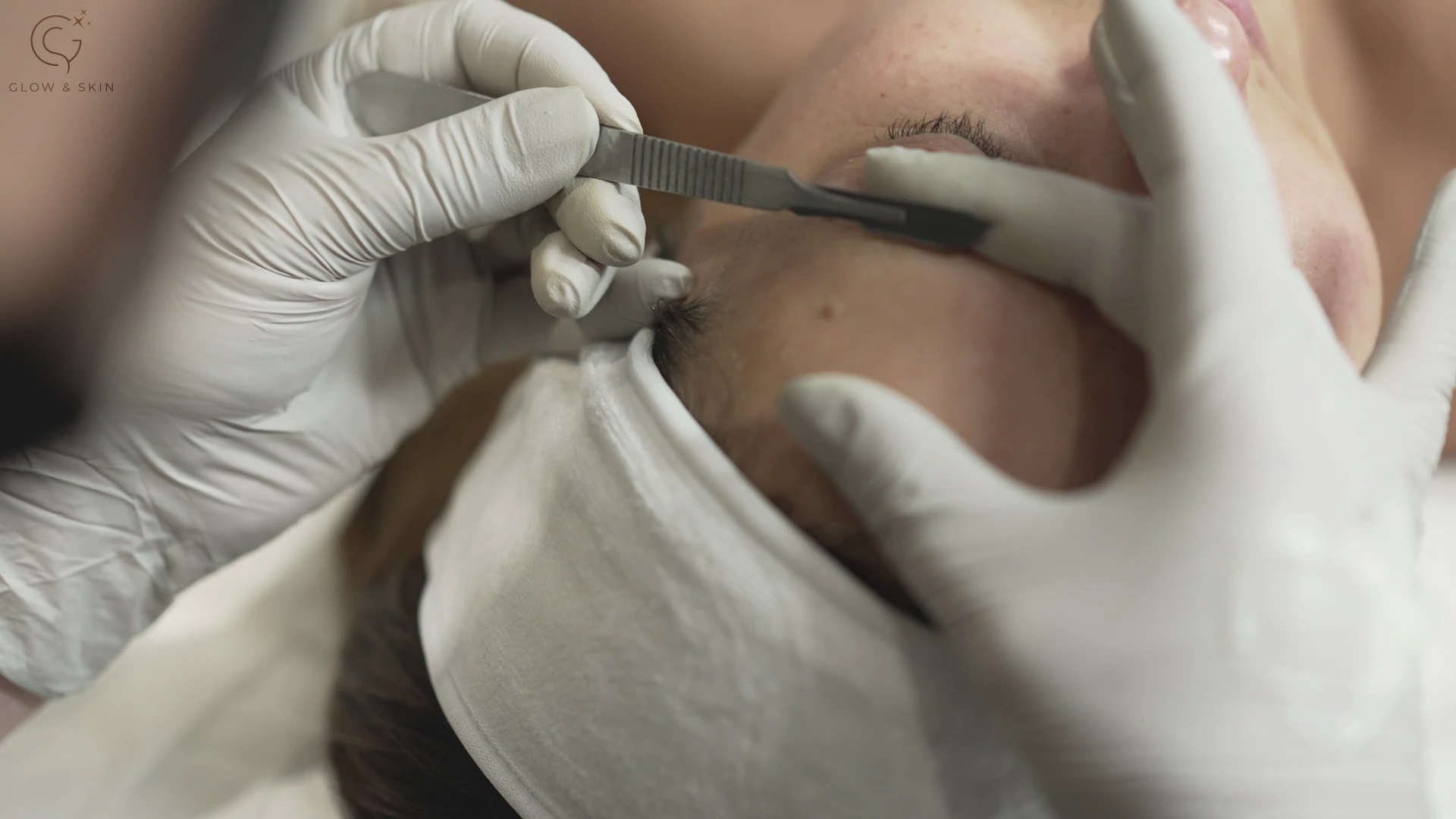 Causes of facial hair and why Dermaplaning offers an ideal solution to facial hair management