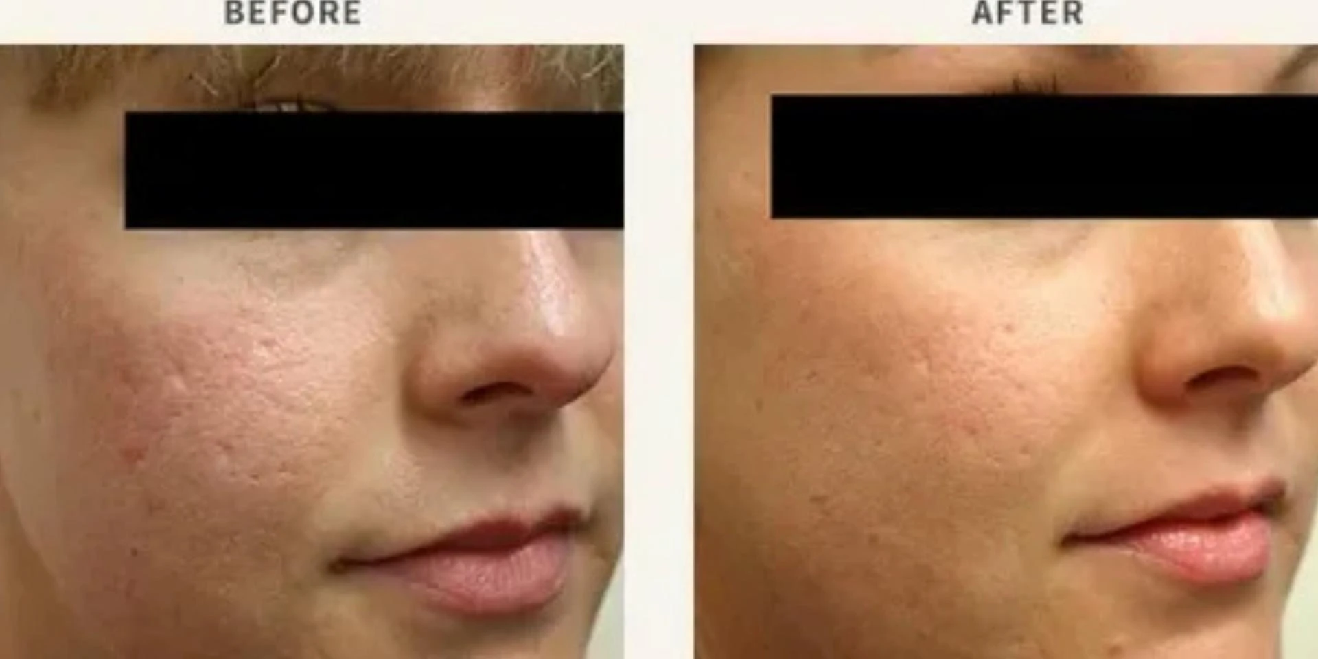 Effective Solutions for Acne Scars: Laser Treatment & Chemical Peels in Delhi