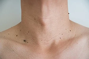 Get Effective Warts Tags Treatment in Delhi at Derma Station