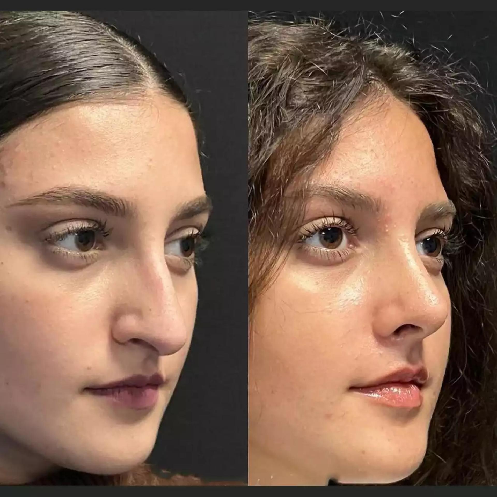 What Makes Rhinoplasty in Dubai Stand Out Globally?
