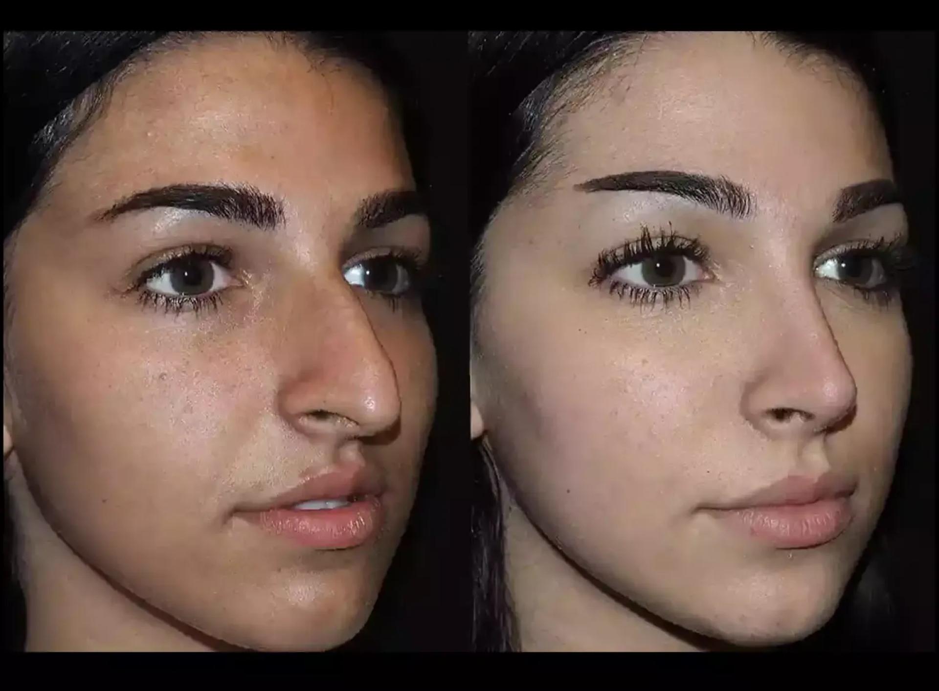 Best Rhinoplasty Surgeon in Dubai for Ethnic Nose Reshaping