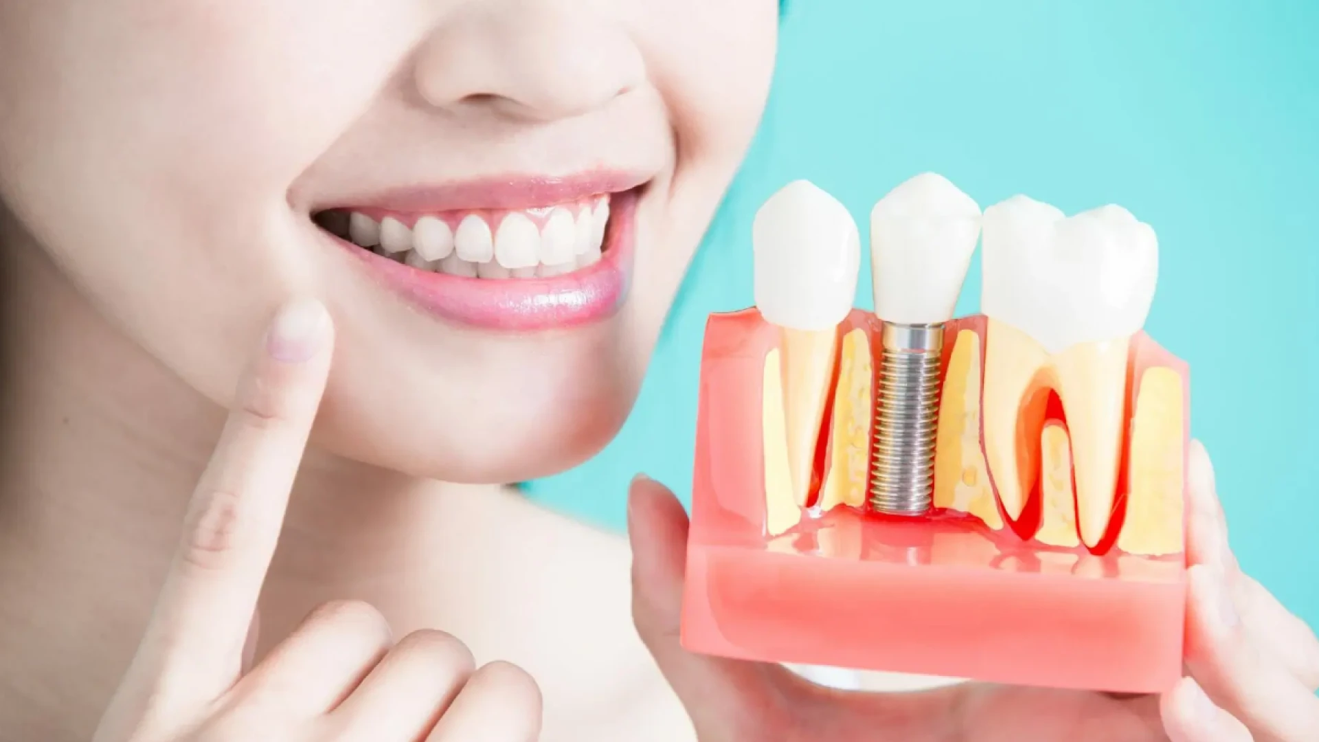 Reclaim Your Smile with Confidence: The Ultimate Guide to Getting a Complete Teeth Set in Chennai
