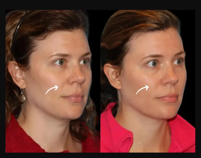 Best Clinics for Sculptra Fillers Treatments in Dubai