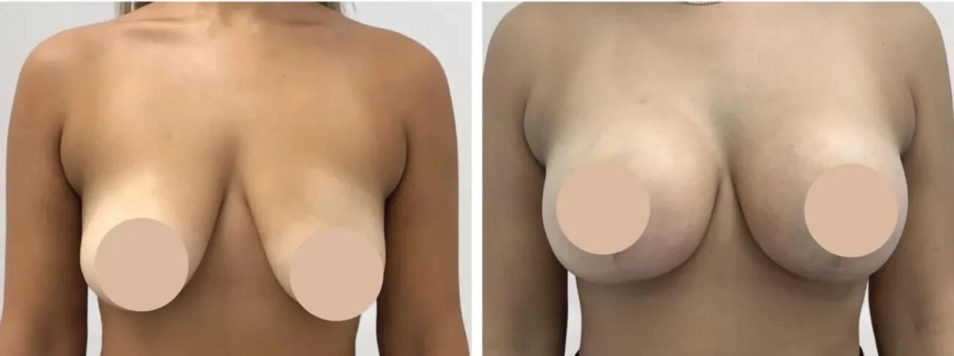 Comparing the Best Breast Lift Surgeons in dubai: How to Make an Informed Choice