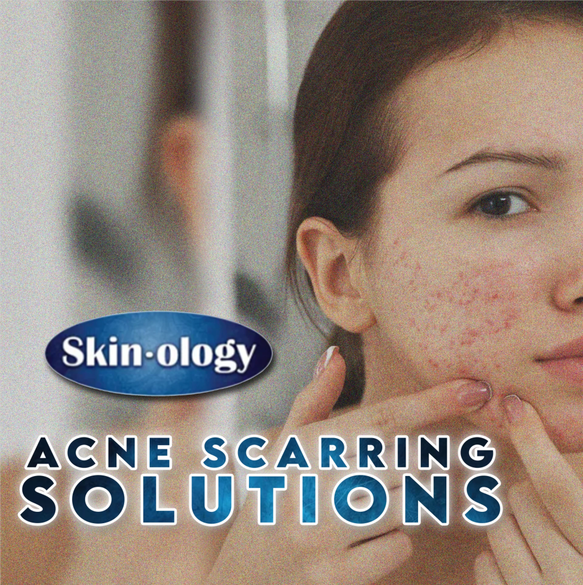 The Ultimate Guide to Acne Scarring Solutions in Mount Olive, Alabama