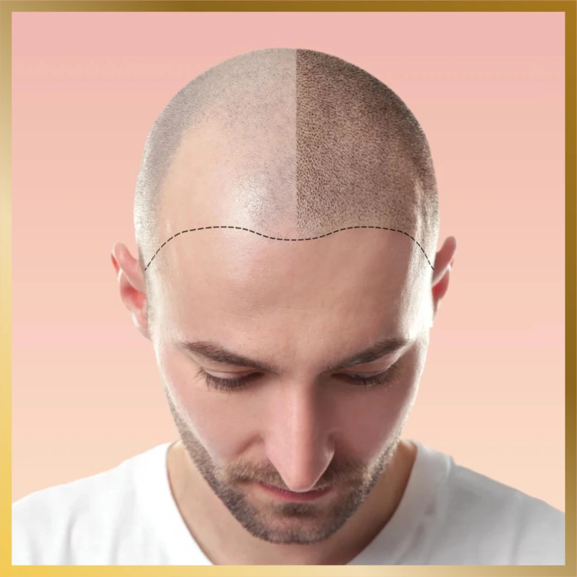 Hair Transplant for Young Adults: What Islamabad Clinics Recommend
