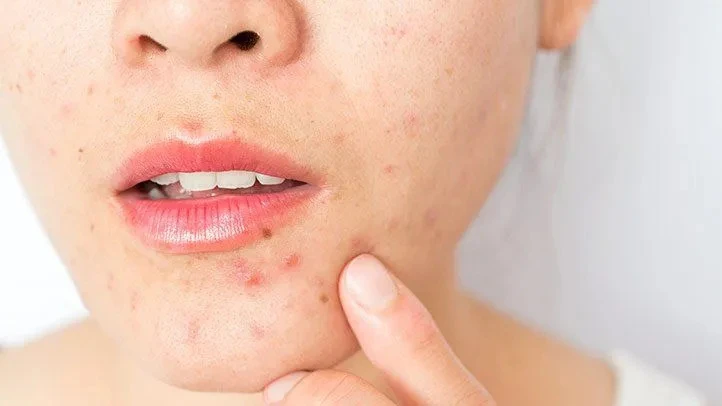 How to Avoid Breakouts: Your Ultimate Guide to Clear, Healthy Skin