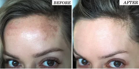 Melasma Treatment for Older Adults: What Islamabad Clinics Offer
