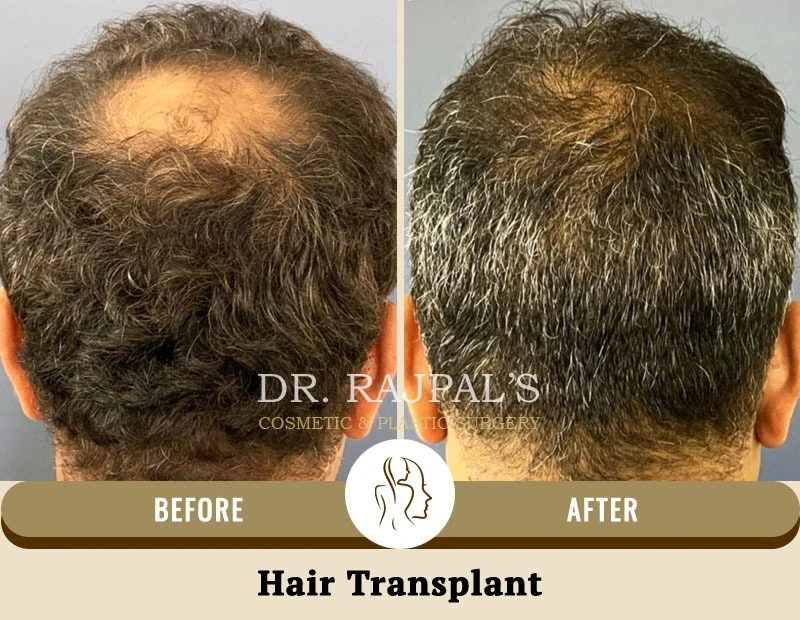 Understanding Hair Transplant Surgery in Delhi: Procedure, Benefits & Pricing