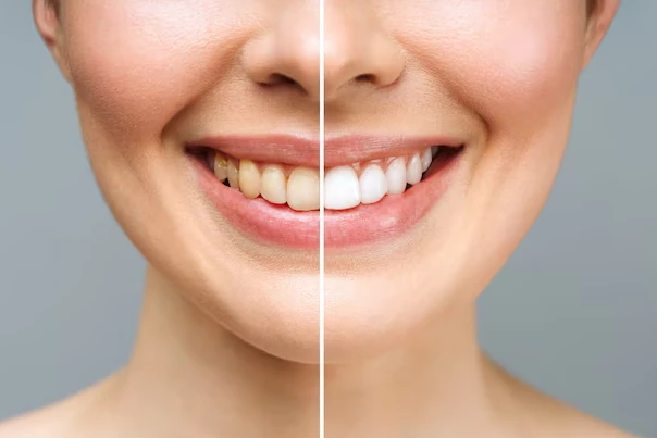 Improve Your Smile With Teeth Whitening