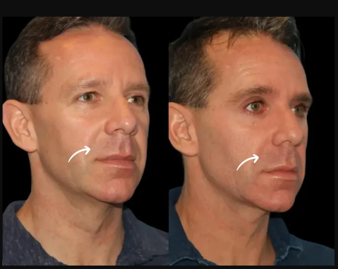 Price vs. Quality: Sculptra Fillers Treatments in Dubai