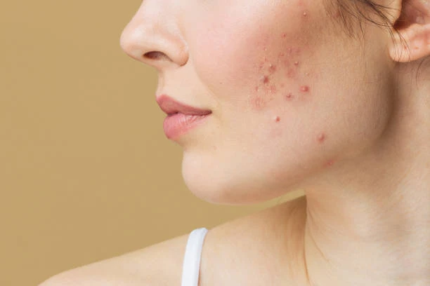 How Young Adults Can Build an Acne-Fighting Skincare Routine