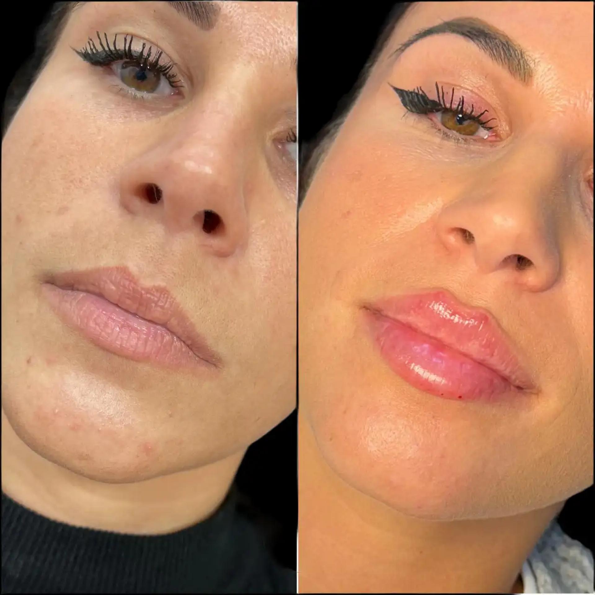 Expert Advice on Fillers in Dubai