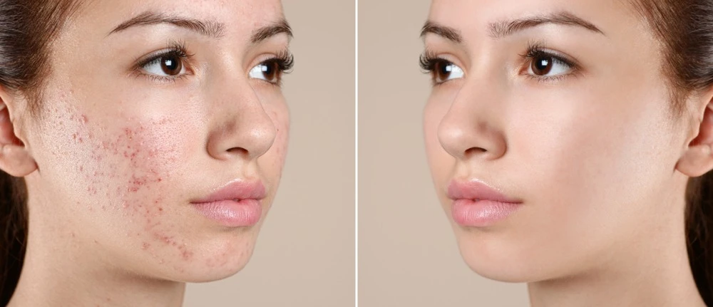 Best Acne Scar Treatment in Delhi – Get Results That Last